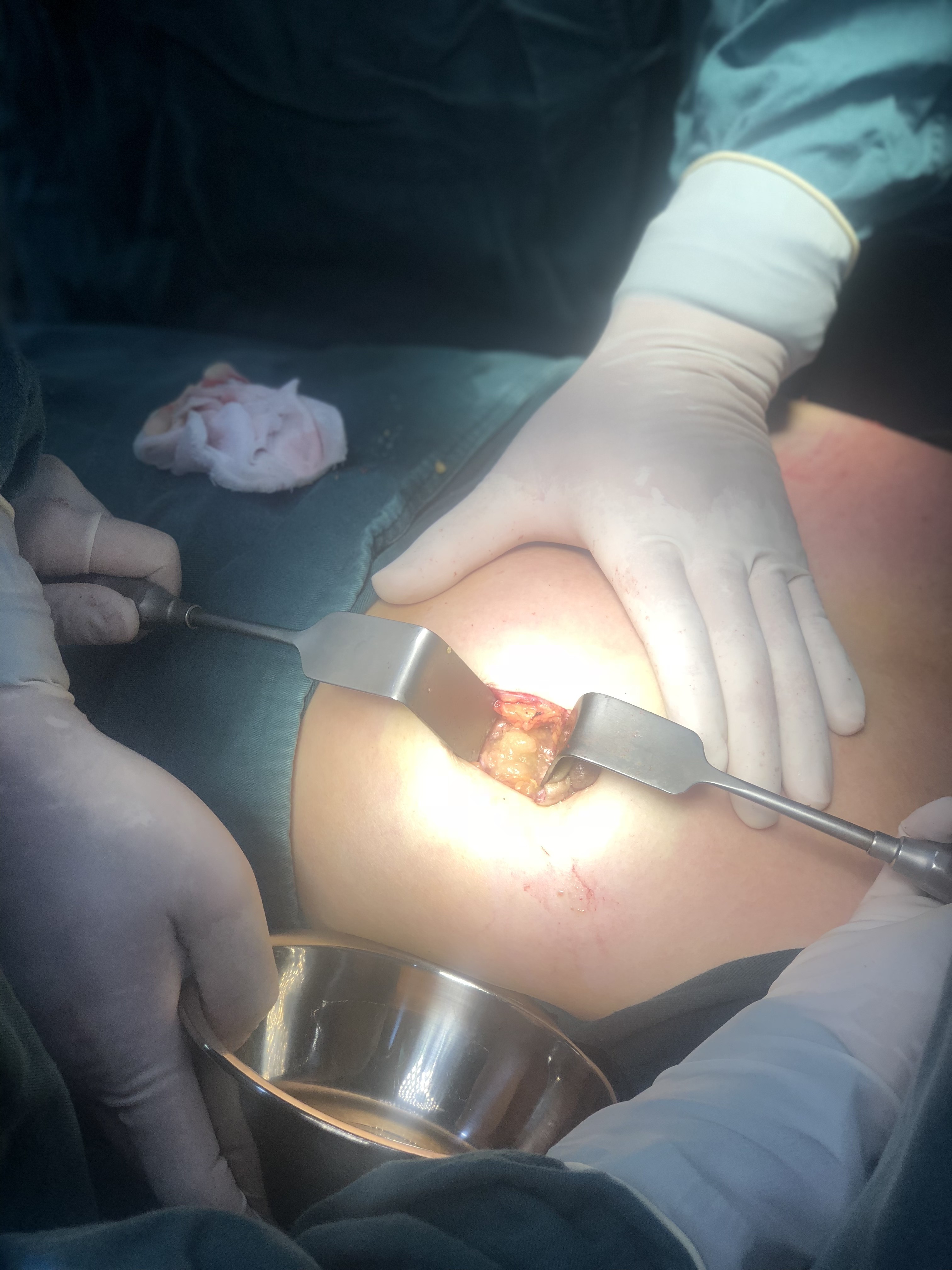 西安医学院第二附属医院医疗美容科隆胸修复怎么样_恢复过程_效果如何