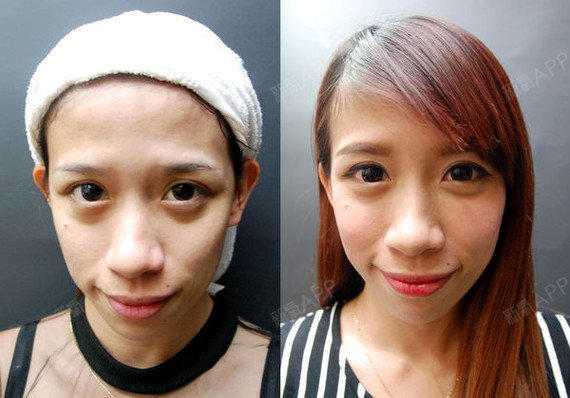 氧气x1ufs玻尿酸丰苹果肌第0天美丽日记