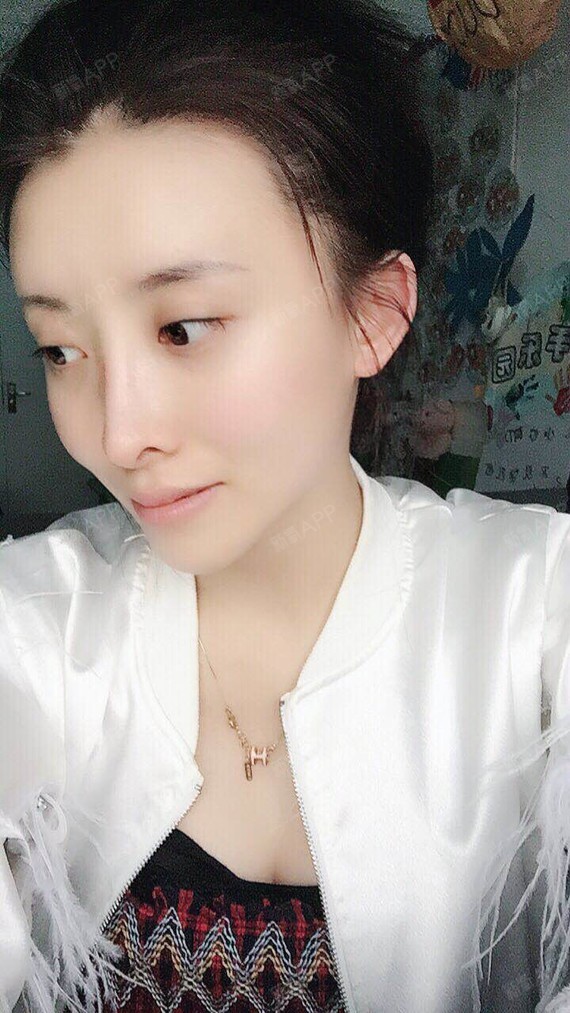 【隆鼻后会不会出现增生的情况】已经三个月了,鼻子已_圈子-新氧美容