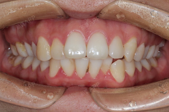 龅牙啊龅牙啊龅牙这个问题真的让我烦恼了很久大家都说我其实长得挺