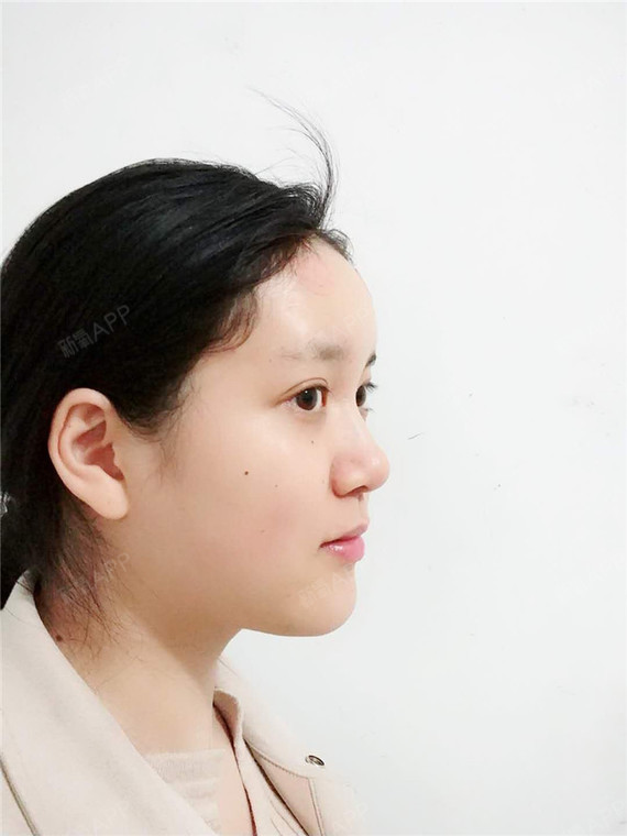 自体脂肪丰眉弓好不好_效果图_雪鸢草飞自体脂肪丰眉弓术后第1天_新氧