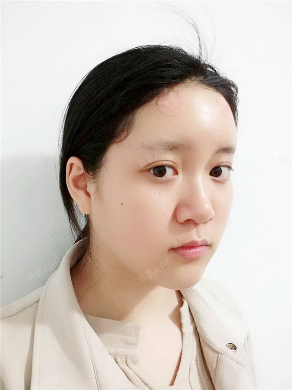 自体脂肪丰眉弓好不好_效果图_雪鸢草飞自体脂肪丰眉弓术后第1天_新氧