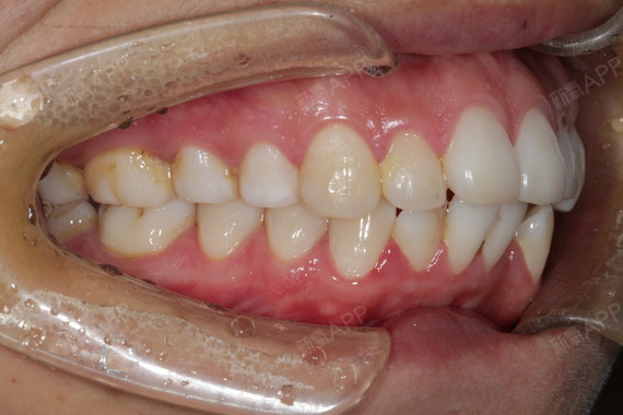 龅牙啊龅牙啊龅牙这个问题真的让我烦恼了很久大家都说我其实长得挺