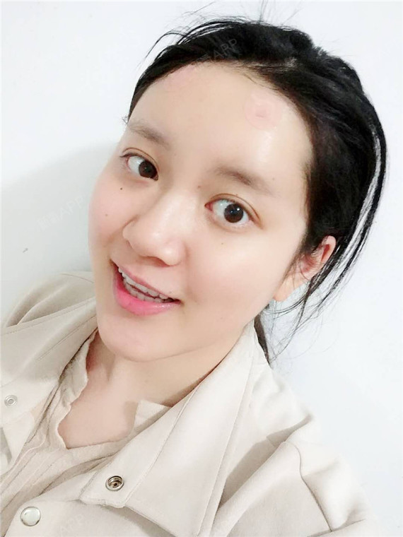 自体脂肪丰眉弓好不好_效果图_雪鸢草飞自体脂肪丰眉弓术后第1天_新氧