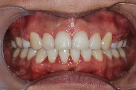 龅牙啊龅牙啊龅牙这个问题真的让我烦恼了很久大家都说我其实长得挺