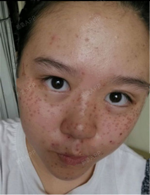 每天都在敷修复面膜,水水的,效果很好,恢复的也很好,激光治疗的黑色素