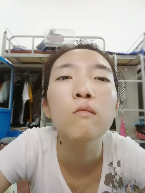 新氧- elvira88 | 唇部 | 术后当自强 | 天津同城 | 唇腭裂手术