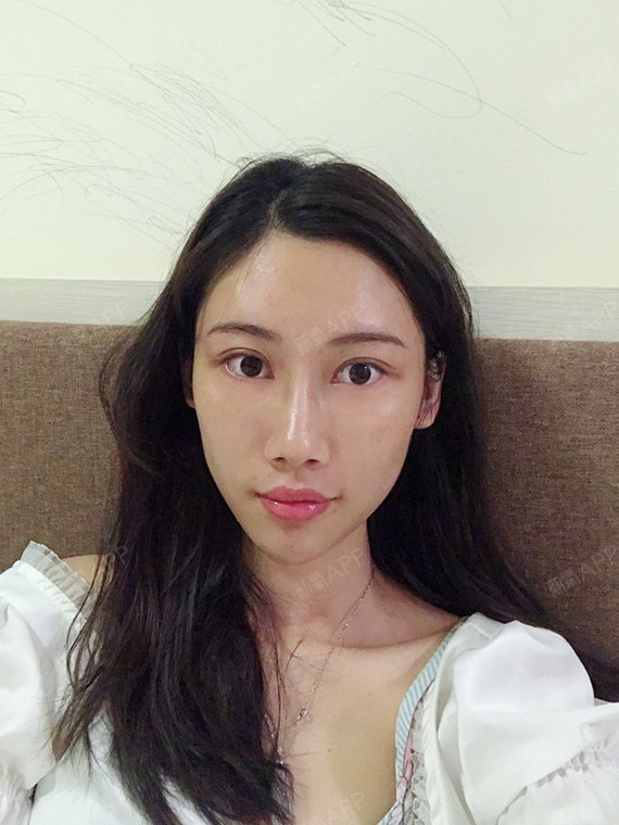 雪吻湿瞳孔自体脂肪丰泪沟术后第3天美丽日记_新氧整形