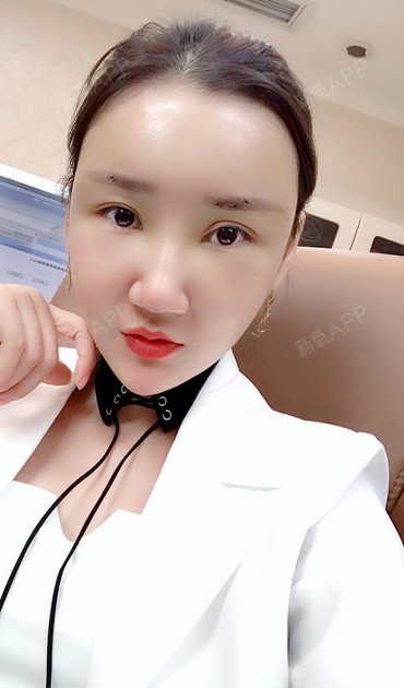 咖喱给给佩自体脂肪全脸填充第72天美丽日记