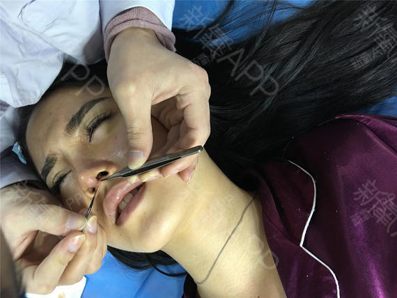 手术缩鼻翼