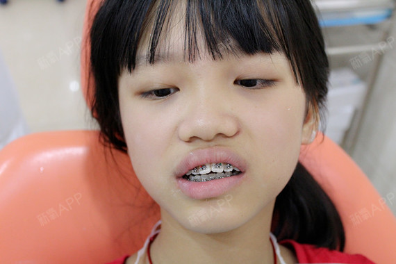 昨天小菇凉终于戴上牙套啦