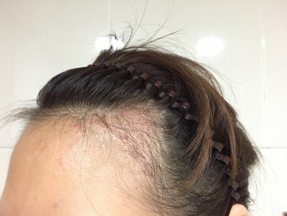 做完手术两个月了到了传说中的脱落期