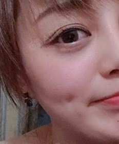 上海酒窝成形术好不好_效果图_氧气h1a58a3酒窝成形术术后第15天_新氧