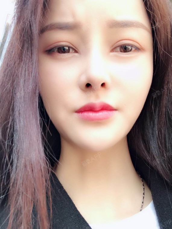 鼻子漂亮后 男友更喜欢粘着我 说女朋友漂亮怕人拐走 圈子 新氧美容整形