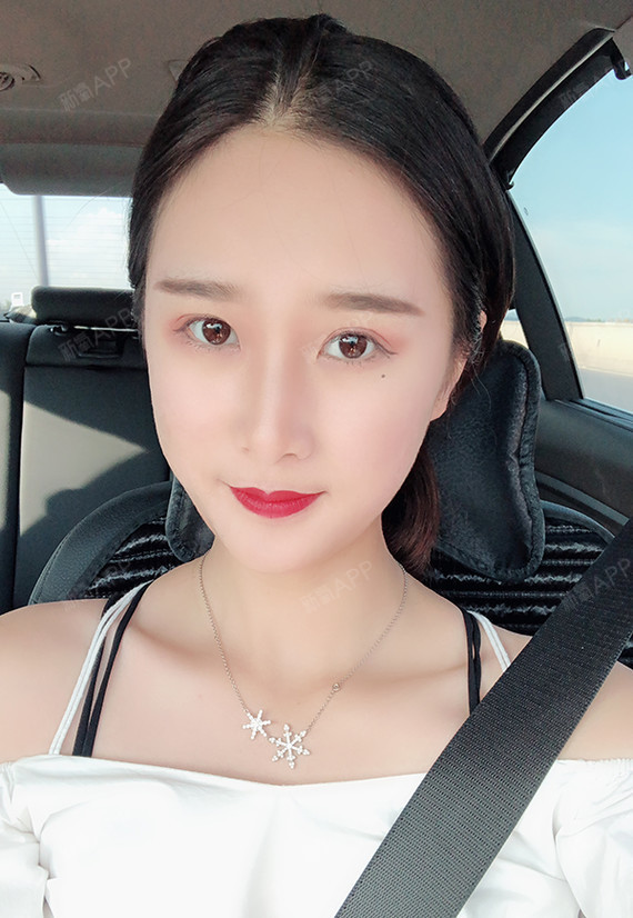 全脸脂肪填充术后第15天:术后半个月了,今天和朋友_圈子-新氧美容整形