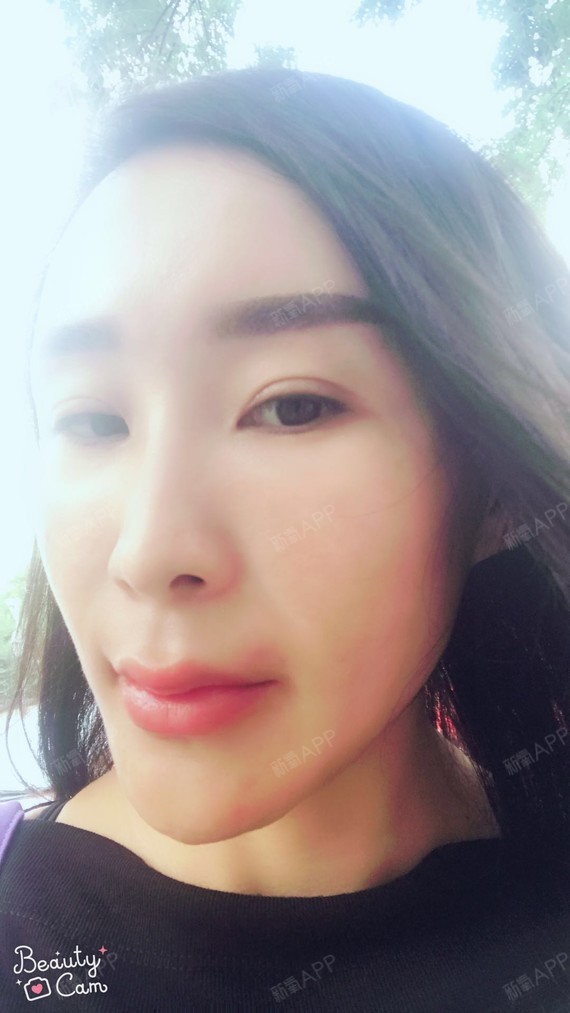 嚒嚒的爱玻尿酸丰唇第2天美丽日记-新氧美容整形
