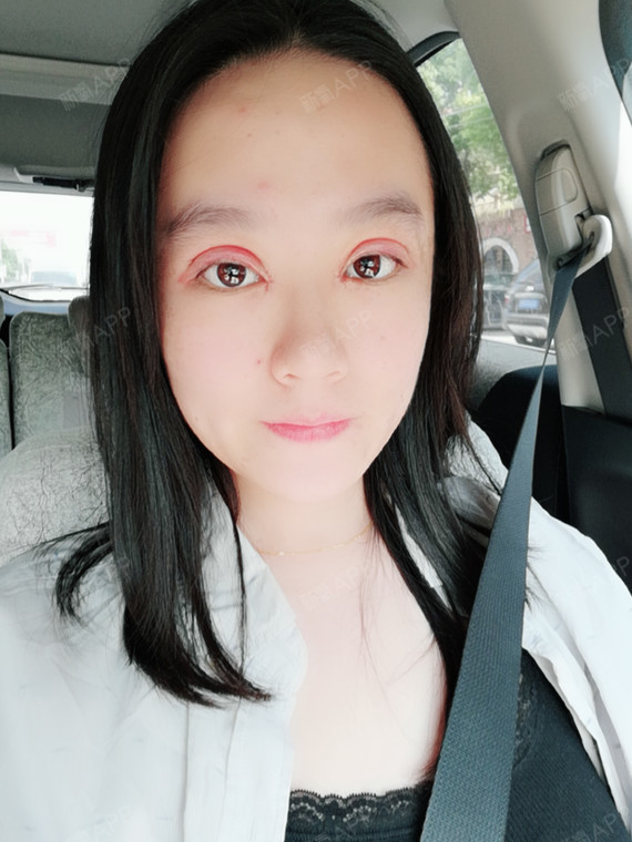 丑嘻嘻眼部综合术后第7天美丽日记_新氧整形