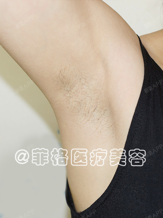 成都脱腋毛好不好_效果图_永远都不要说永远脱腋毛术后第67天_新氧