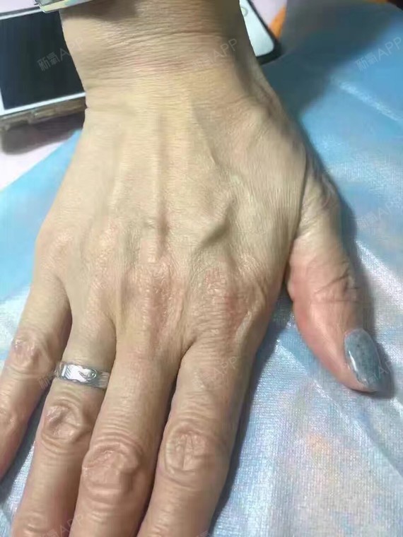 手部活细胞再生_圈子-新氧美容整形