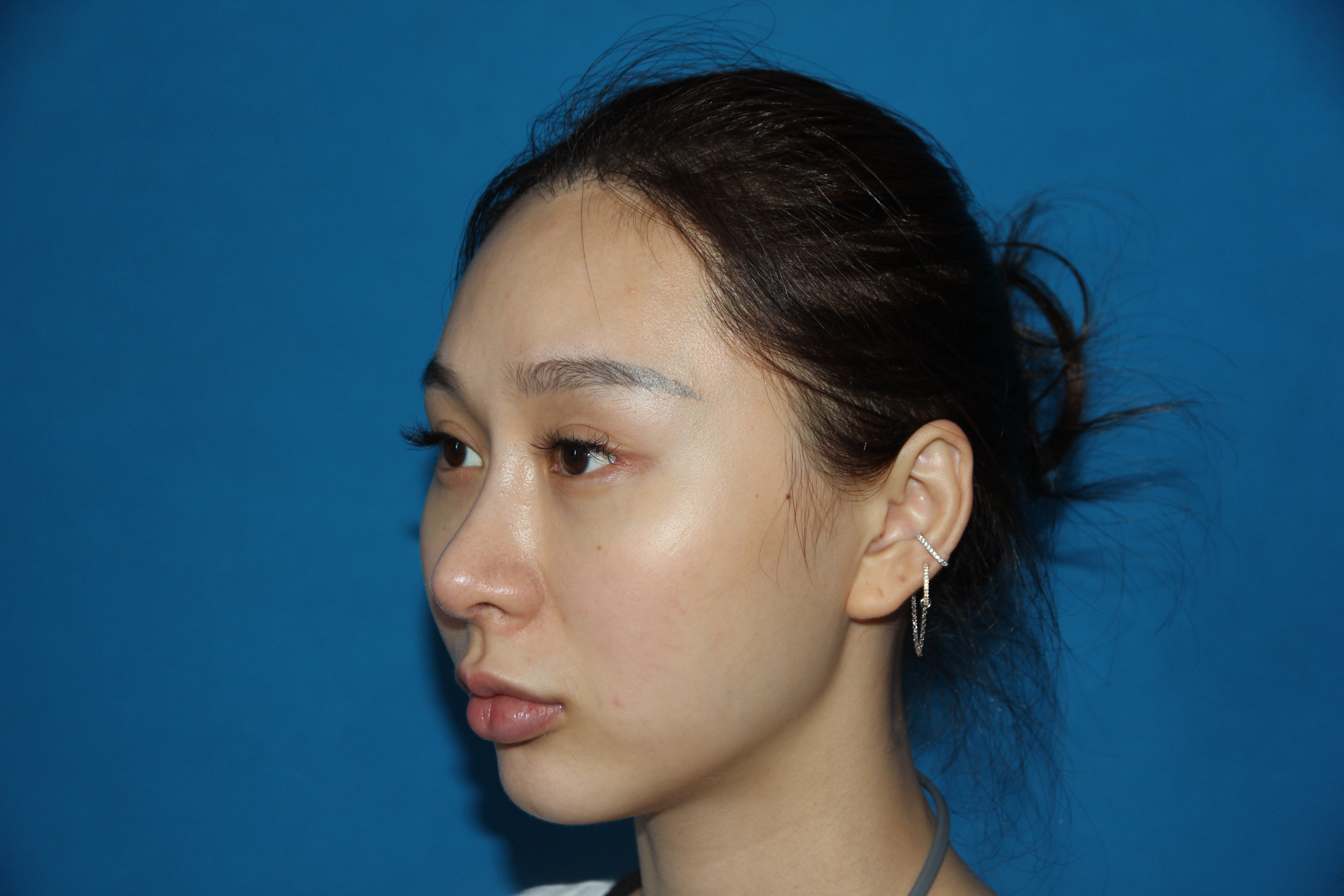 九儿啊的美丽日记"9.8"颧骨内推