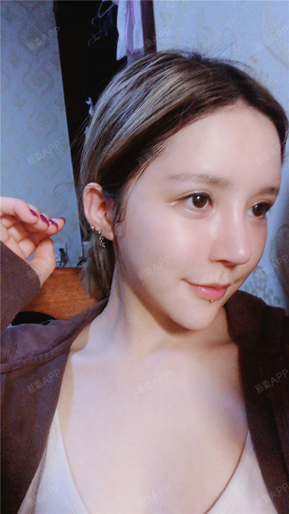 肋软骨隆鼻好不好_效果图_大城漫小爱肋软骨隆鼻术后第8天_新氧美容