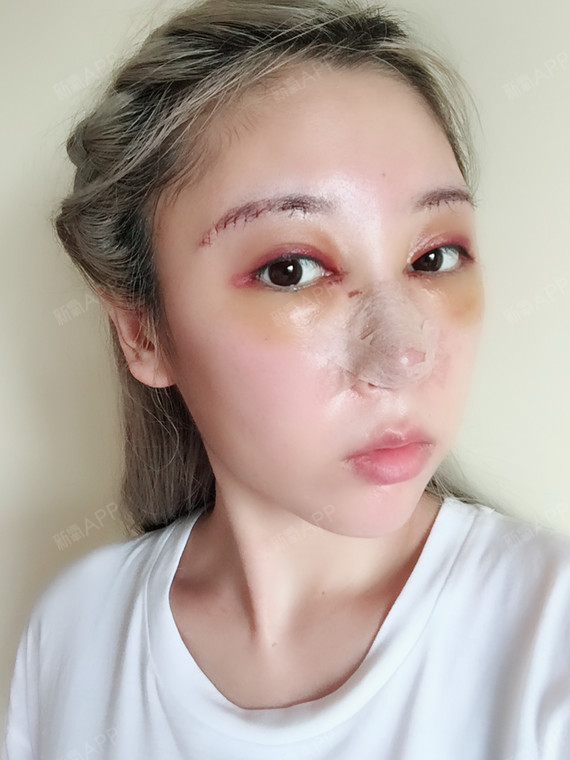 氧气lyi1fb4切眉术第2天美丽日记