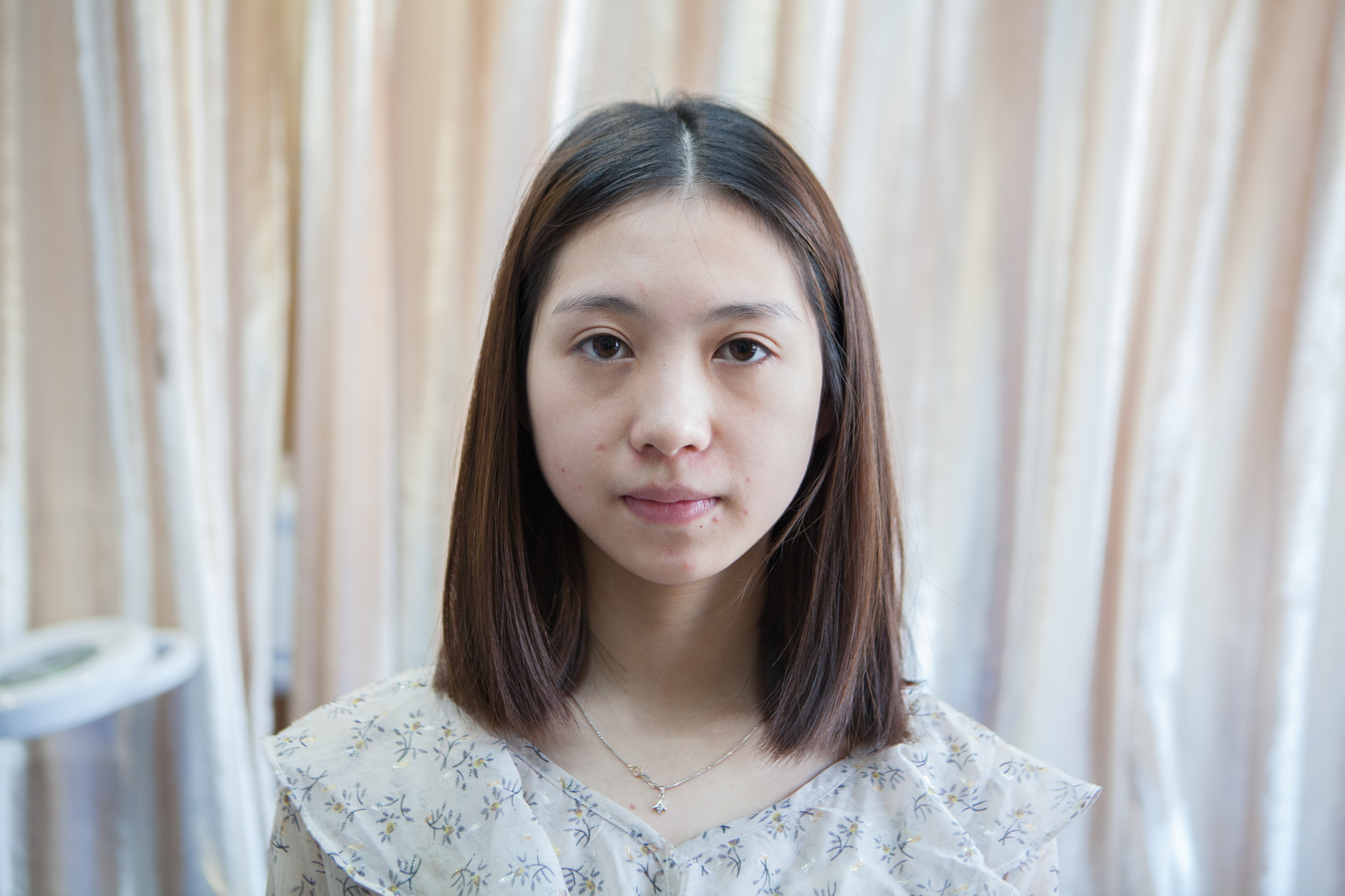 广州美莱医疗美容玻尿酸全脸填充怎么样_恢复过程_效果如何_leev整形