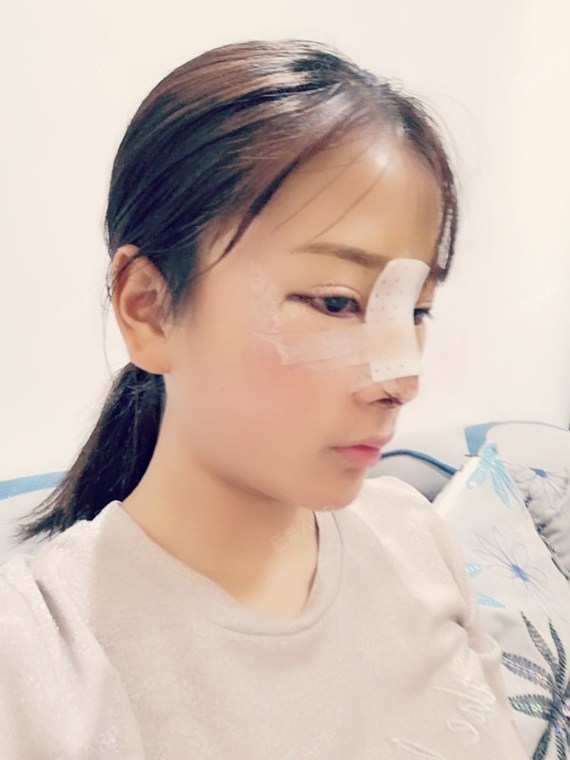 南京耳软骨复合隆鼻好不好_效果图_一半午夜耳软骨复合隆鼻术后第4天