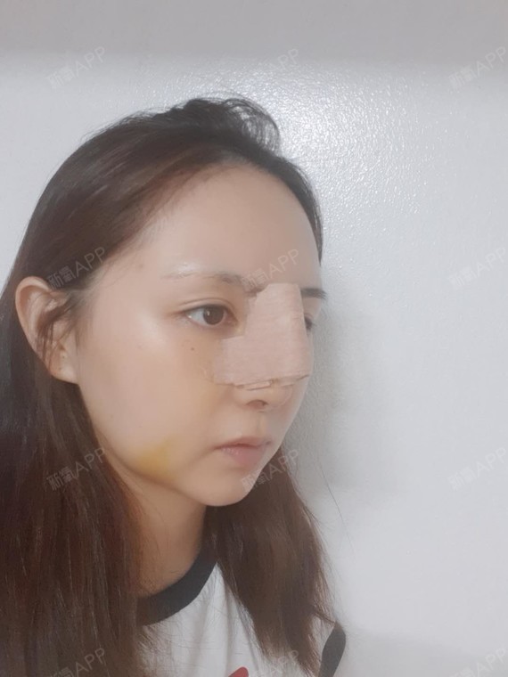 kulalaku鼻综合术后第7天美丽日记_新氧整形
