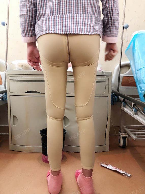 吸脂瘦大腿好不好_效果图_时尚女生佩佩吸脂瘦大腿术后第3天_新氧美容