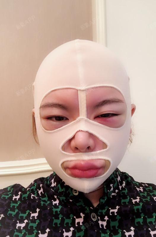 今天是术后一天,闲着没事抽空来写个自己做完的感受