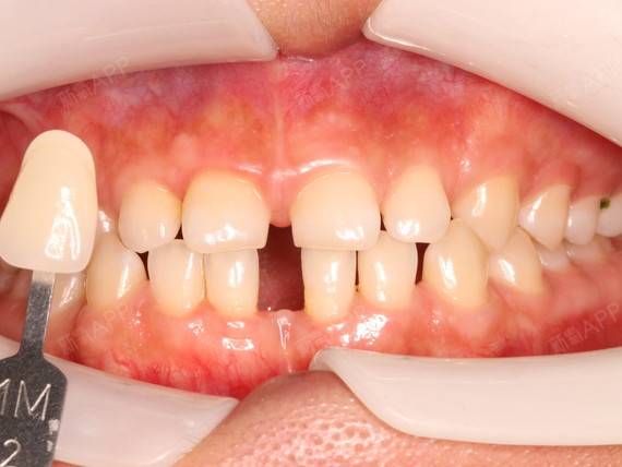 给我拍的  医生建议我做贴面,这样可以把缝隙遮住,但就是怕我牙缝大