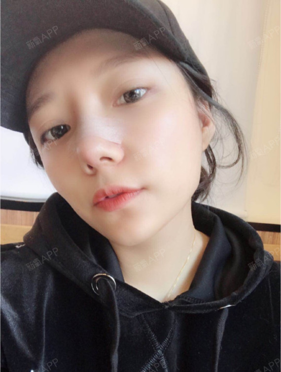 这是术后第七天的照片!今天拆线了,拆完线立马去跟_圈子-新氧美容整形