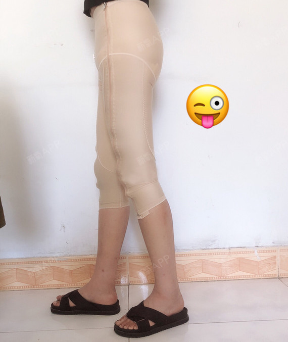 【青岛华颜美-射频溶脂瘦大腿术后第31天】