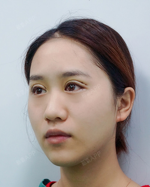 fasf埋线双眼皮第0天美丽日记