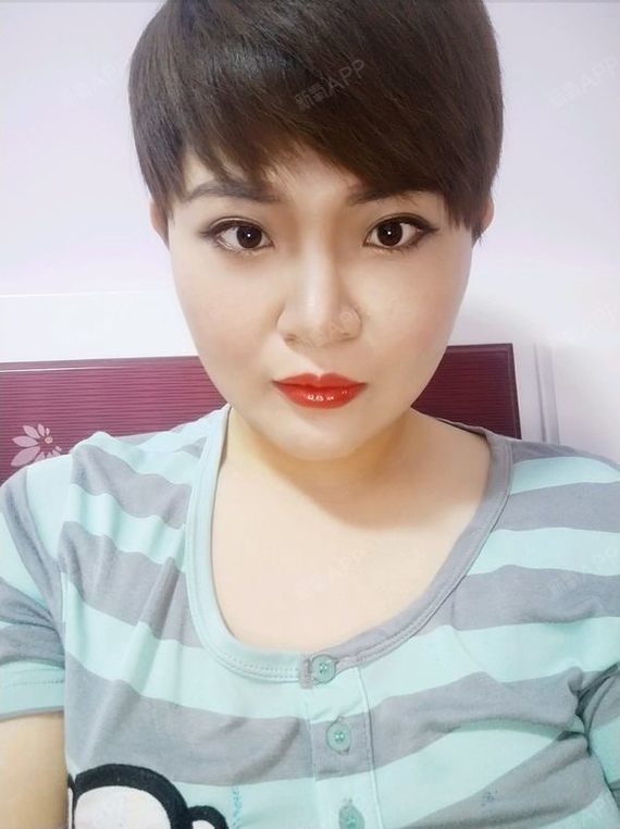 不想要脸瘦的太夸张,林医生给我打的正合我意,脸瘦了_圈子-新氧美容