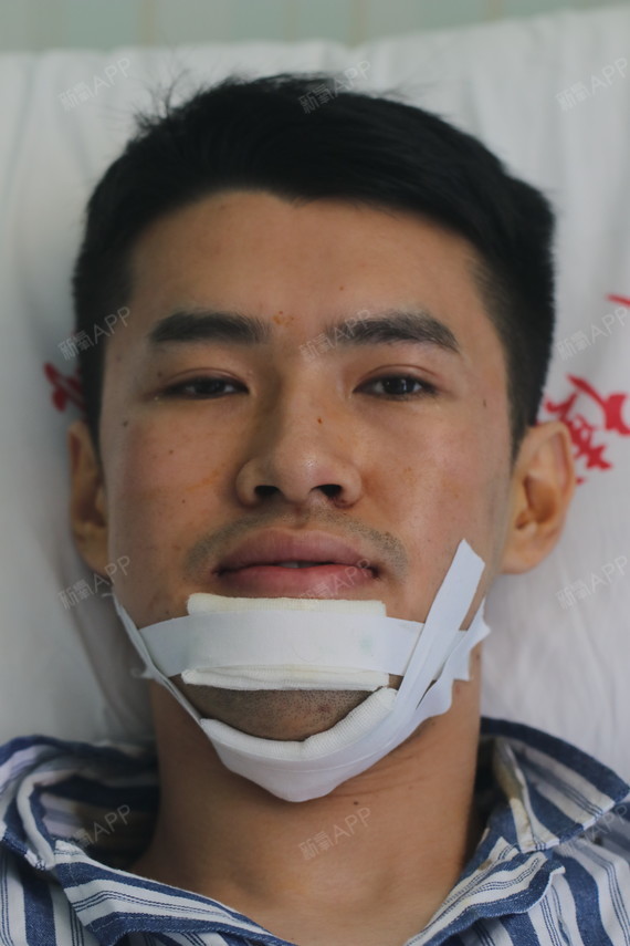 上海中博口腔医院—地包天(单鄂手术)