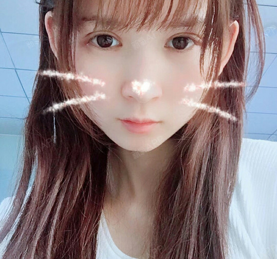 大眼萌芭比娃娃眼部综合术后第18天美丽日记_新氧整形