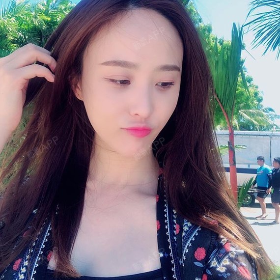 埋线隆鼻好不好_效果图_氧气srsff65埋线隆鼻术后第18天_新氧美容整形