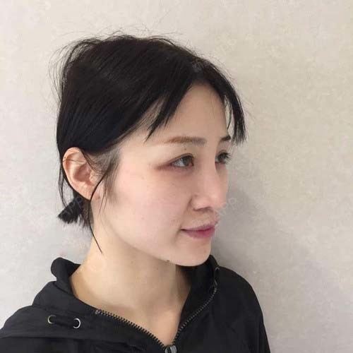 我术前的鼻子就是不好看,鼻梁塌,鼻翼宽,心情好如果_圈子-新氧美容