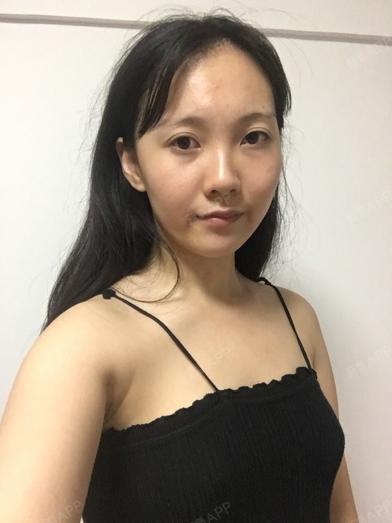 武汉假体隆胸好不好_效果图_我把酒奉陪假体隆胸术后第0天_新氧美容