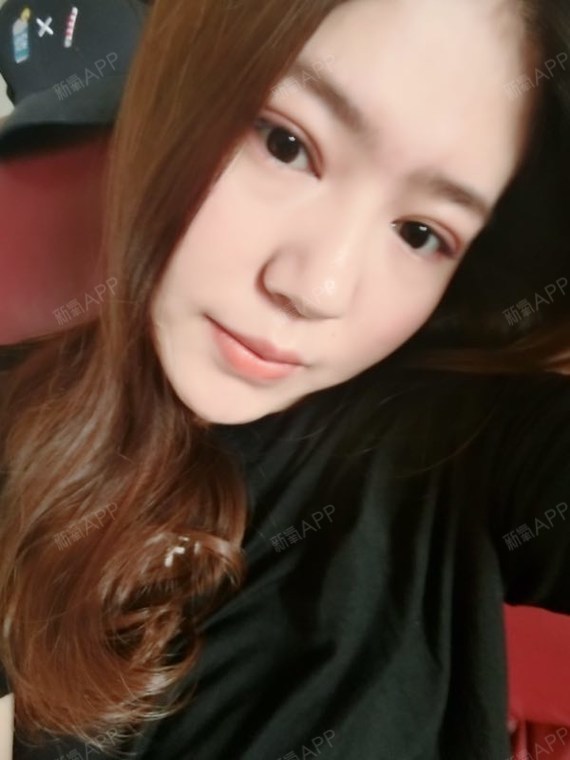 切开双眼皮好不好_效果图_森露切开双眼皮术后第14天_新氧美容整形