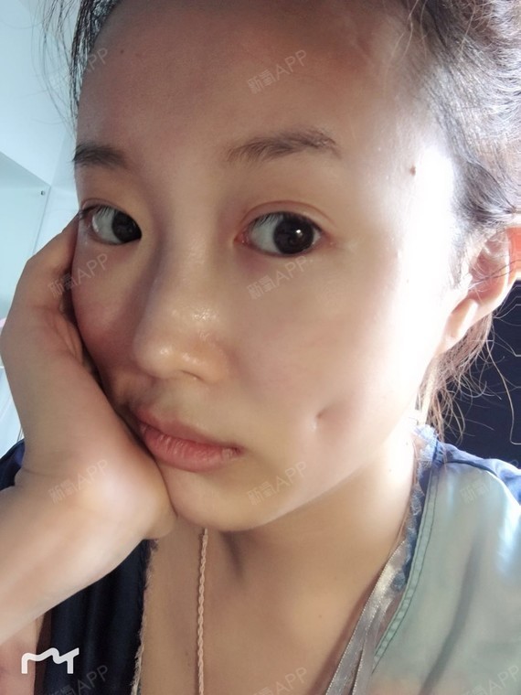 【埋线酒窝】想有酒窝很久了,以前总归笑起来有浅浅的_圈子-新氧美容