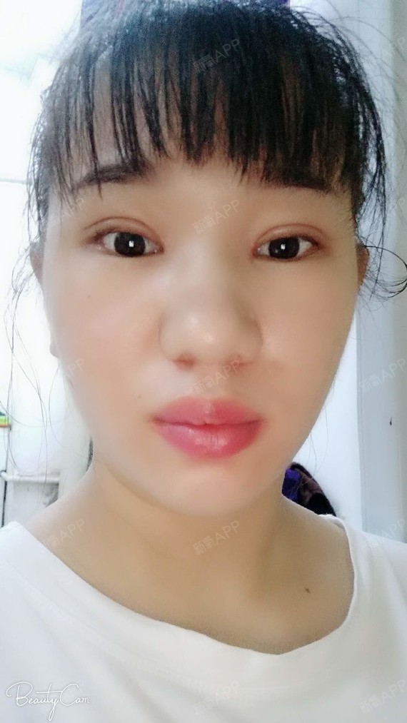 埋线双眼皮