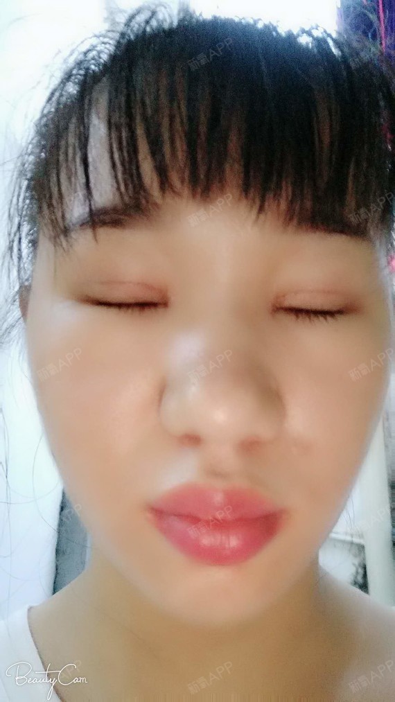 埋线双眼皮