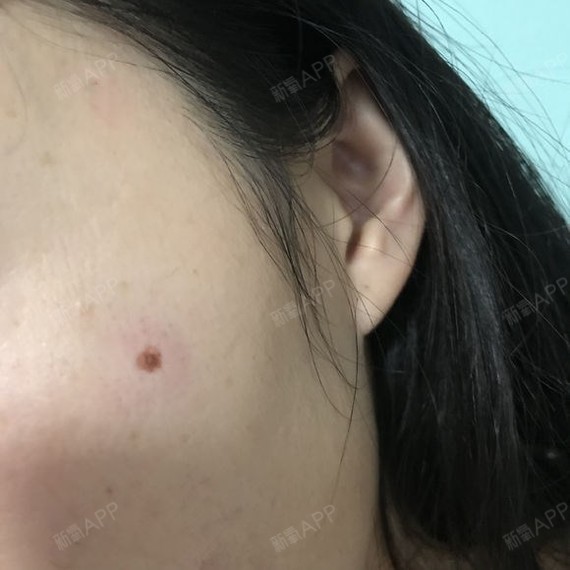 俨然激光点痣第4天美丽日记