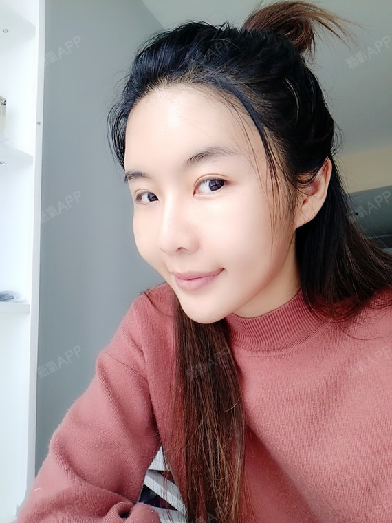 自体脂肪全脸填充好不好_效果图_繁花似锦w自体脂肪全脸填充术后第15