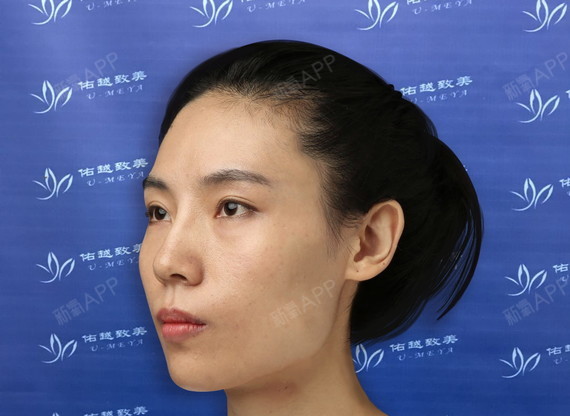 下颌面3天:下颚角切除和颧弓内推手术第三天:昨晚睡_圈子-新氧美容