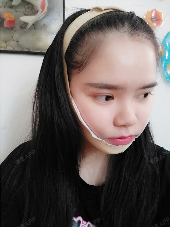 看我这婴儿肥的一大圆脸胖嘟嘟的在网上了解了一下整形项目就想做一个