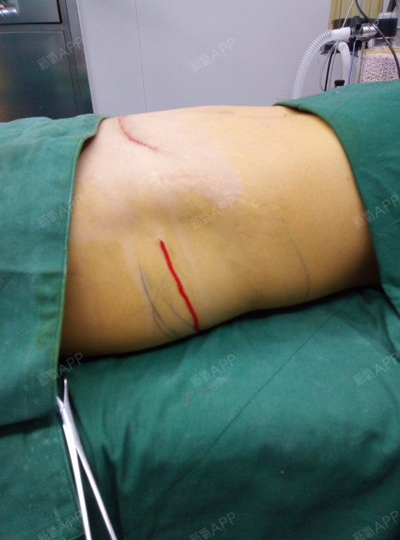 成形术好不好_效果图_梦在一年四季腹壁成形术术后第2天_新氧美容整形